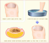 [손톱과 발톱건강 특집 2] 조갑감입 ‘ingrowing nail’이란?
