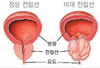 노인성 질환 “전립선 질병” 바로알기